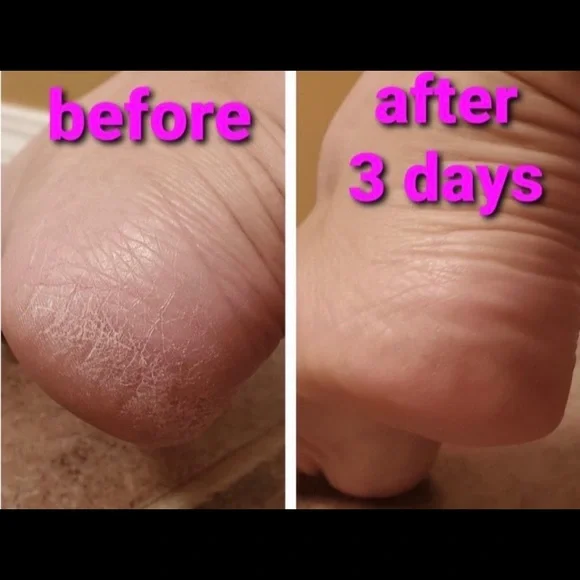- (2) TWO Epoch NuSkin Sole Solution foot treatment